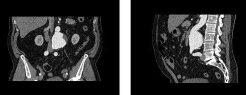 WEK53-05腹部模體，WEK53-05動(dòng)脈瘤腹部模體，WEK53-05 CT血管造影模型成像