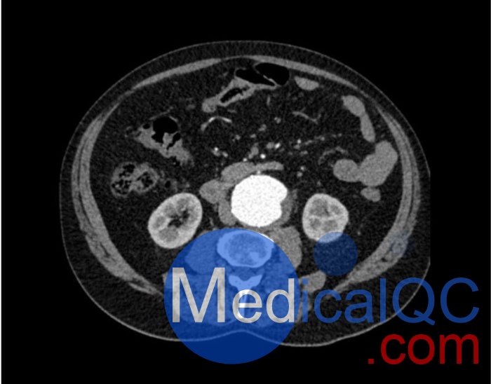 WEK53-05腹部模體，WEK53-05動(dòng)脈瘤腹部模體