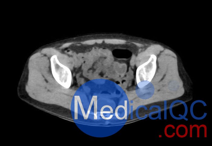 WEK55-02腹部骨盆模體，WEK55-02腹部骨盆模型成像效果圖