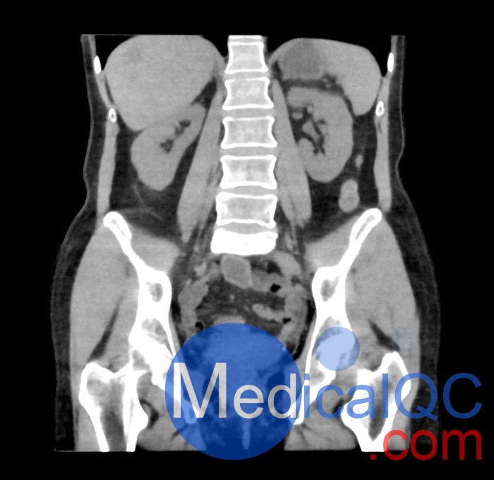 WEK55-02腹部骨盆模體，WEK55-02腹部骨盆模型成像效果圖